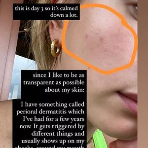 Hailey Bieber revelou, por meio das redes sociais, que sofre com dermatite perioral, uma condição inflamatória comum, especialmente entre mulheres de 25 a 49 anos