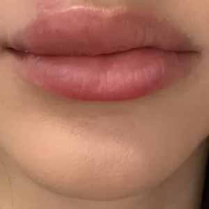 Bruna Biancardi mostrou como estão seus lábios dias após o início do tratamento