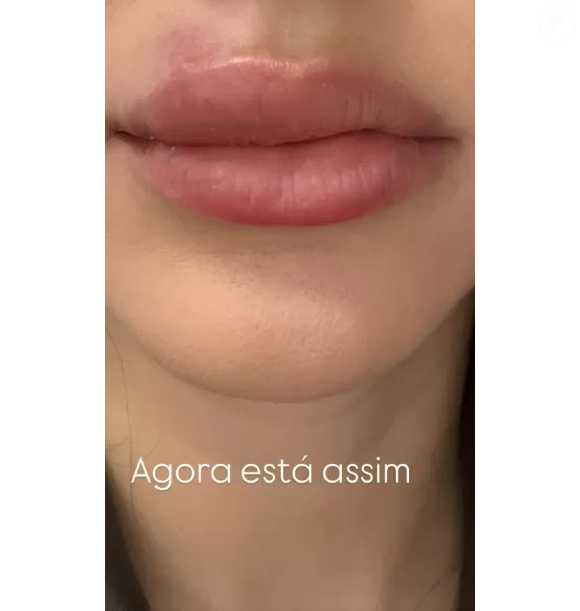Bruna Biancardi mostrou como estão seus lábios dias após o início do tratamento
