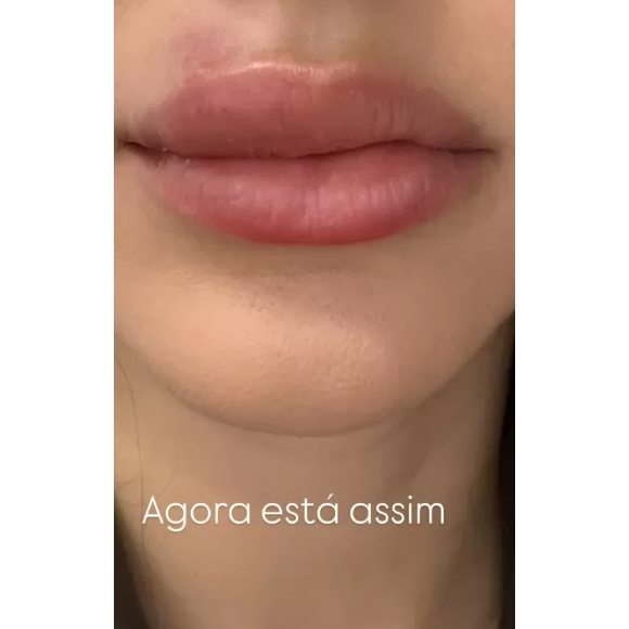 Bruna Biancardi mostrou como estão seus lábios dias após o início do tratamento