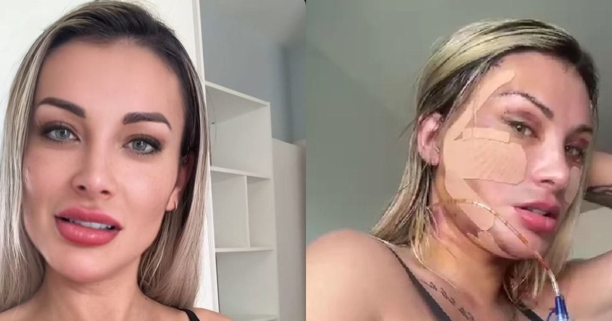 Andressa Urach hiện thế nào sau ca phẫu thuật thẩm mỹ trị giá 100.000 reais? Với chiếc đầu được băng bó, người nổi tiếng trên mạng xã hội này khoe khuôn mặt với những vết khâu: 'Tôi đã trải qua ca phẫu thuật nổi tiếng...': Ảnh - Purepeople