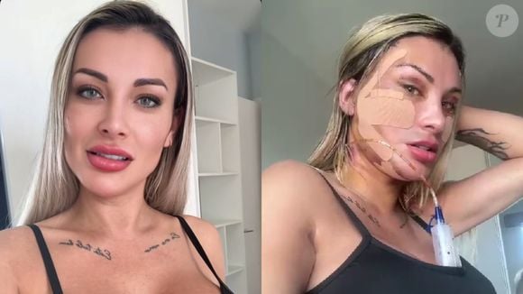 Como está Andressa Urach após nova plástica de R$ 100 mil? Influenciadora mostra rosto com pontos: 'Fiz o famoso...'