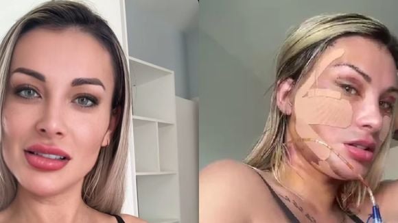 Como está Andressa Urach após nova plástica de R$ 100 mil? Com a cabeça enfaixada, influenciadora mostra rosto com pontos: 'Fiz o famoso...'
