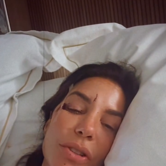 Ivete Sangalo mostrou o rosto ferido aos seguidores