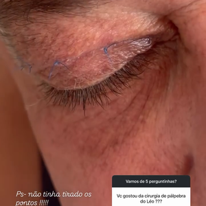 Leonardo fez cirurgia plástica: a blefaroplastia visa rejuvenescer a área periorbital através da retirada do excesso de pele e bolsas de gordura presentes nas pálpebras