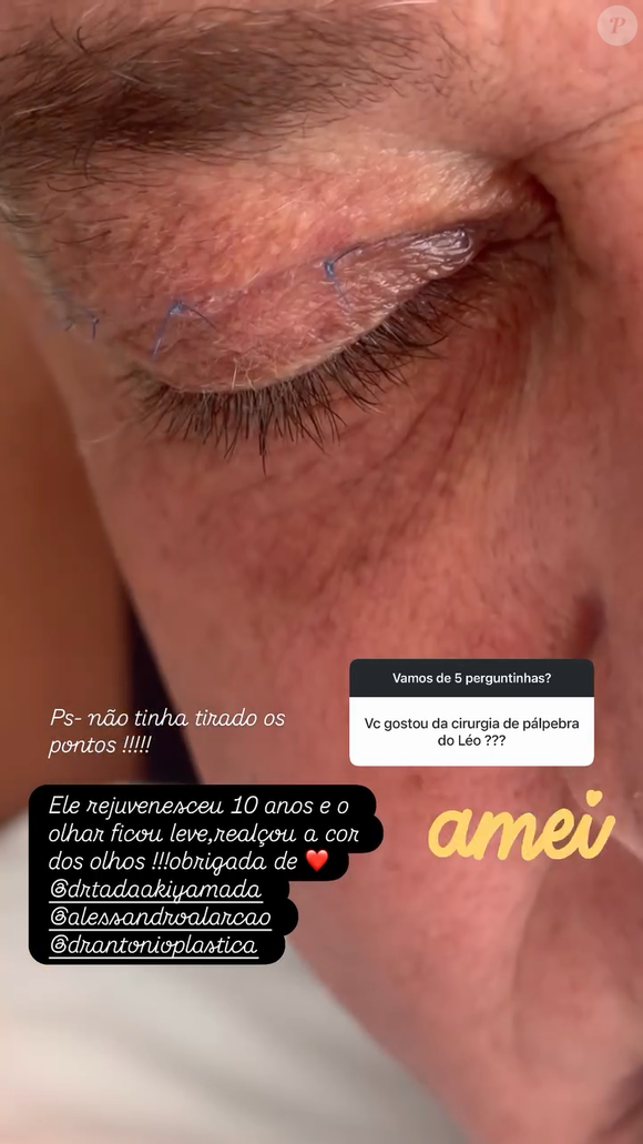 Leonardo fez cirurgia plástica: a blefaroplastia visa rejuvenescer a área periorbital através da retirada do excesso de pele e bolsas de gordura presentes nas pálpebras