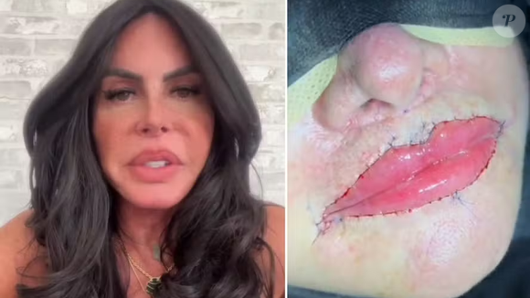 Gretchen sem PMMA! Famosa remove substância polêmica dos lábios e exibe resultado: 'Minha boca agora está perfeita'