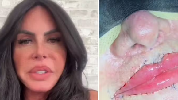 Gretchen sem PMMA! Famosa remove substância polêmica dos lábios e exibe resultado: 'Minha boca agora está perfeita'