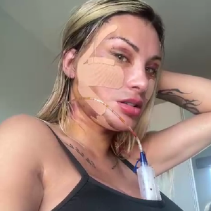Andressa Urach revelou ter gastado R$ 100 mil com a cirurgia que, segundo ela, a fará rejuvenescer 15 anos: "Vou voltar a ter 23"