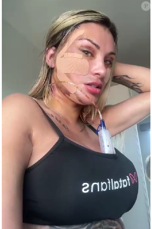 Andressa Urach revelou ter gastado R$ 100 mil com a cirurgia que, segundo ela, a fará rejuvenescer 15 anos: "Vou voltar a ter 23"